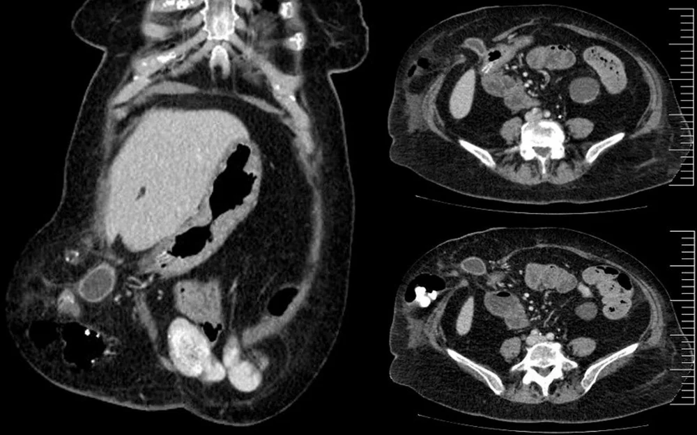Tomografía computarizada abdominal: hernia paraestomal en el flanco derecho que contiene parte de la vesícula biliar y el colon, en vista coronal y en dos cortes axiales
